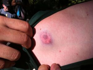 An example of paintball bruising